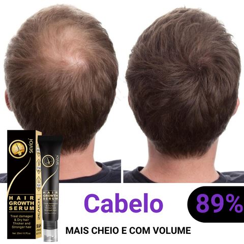 HairMax Pró© | Diminui Queda 95% Aumenta Crescimento 20x | Pague 1 Leve 2 Wons Store 