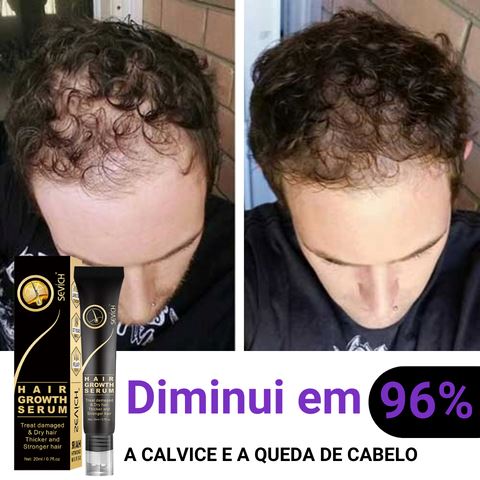 HairMax Pró© | Diminui Queda 95% Aumenta Crescimento 20x | Pague 1 Leve 2 Wons Store 